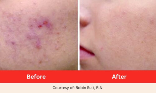 SD Vein Body Skin Resurfacing and Acne Laser Therapy before after
