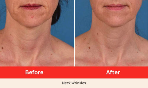 Before After Neck Wrinkles Microneedling SkinPen