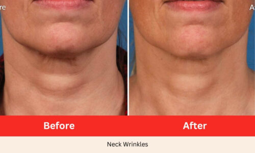 Before After Neck Wrinkles Microneedling SkinPen