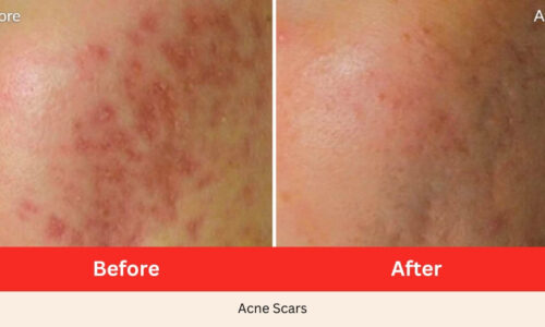 Before After acne scars Microneedling SkinPen