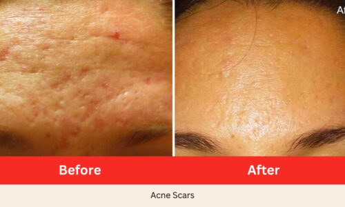 Before After acne scars Microneedling SkinPen