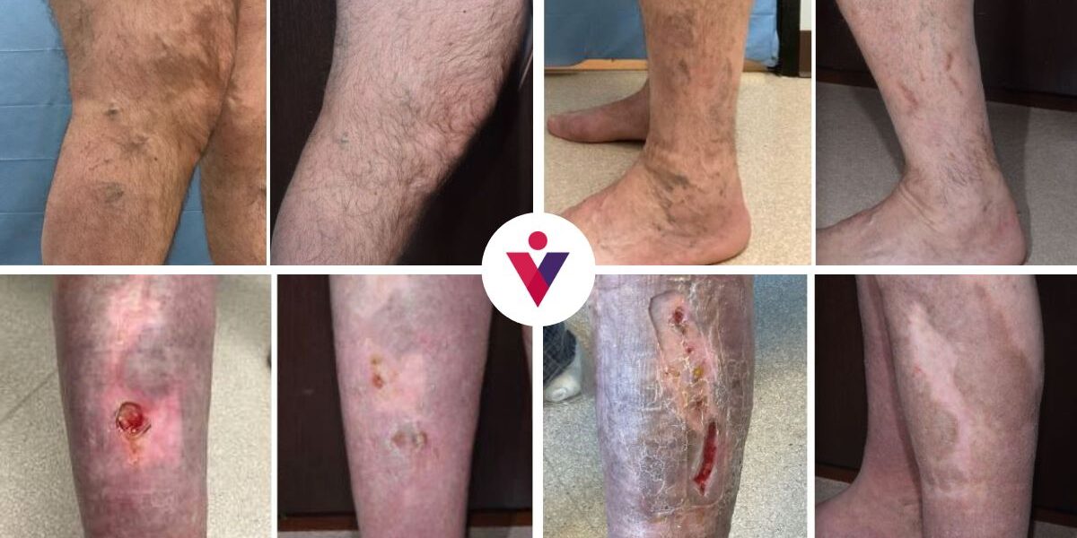 Chronic and Acute Venous Insufficiency Before and After Chronic and Acute Venous Insufficiency Before and After
