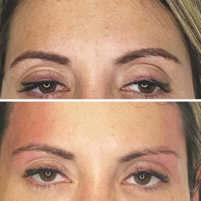 Eyebrow Lifting Laser Therapy Before & After