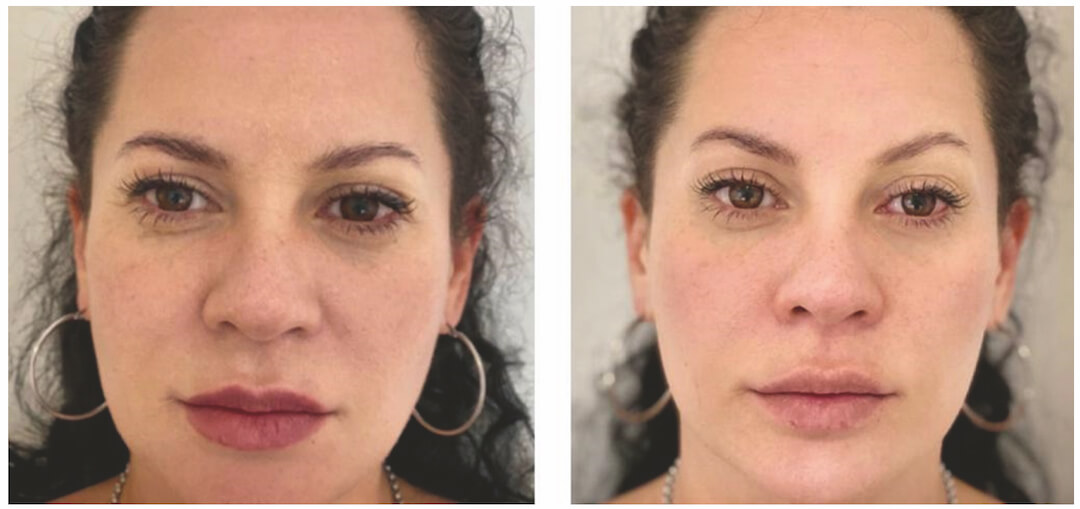 Eyebrow Lifting Laser Therapy Before & After