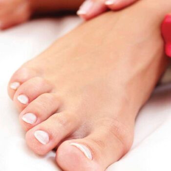Onychomycosis Fungal Nail Infection Laser Treatment