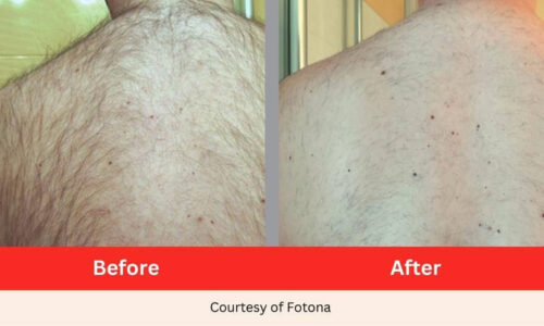 SD Vein Body Hair Removal Laser Therapy before after (1)