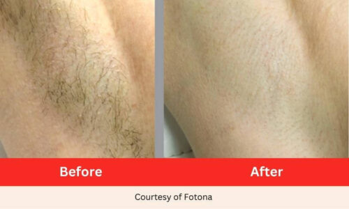 SD Vein Body Hair Removal Laser Therapy before after (3)
