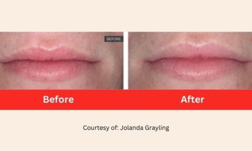 SD Vein Body Non-invasive Lip Plump Laser Therapy before after 3