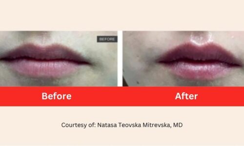 SD Vein Body Non-invasive Lip Plump Laser Therapy before after2