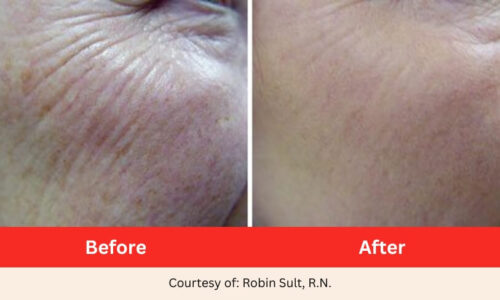 SD Vein Body Skin Resurfacing and Acne Laser Therapy before after 2