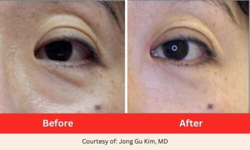 SD Vein Eye Wrinkles Laser Therapy 2