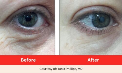 SD Vein Eye Wrinkles Laser Therapy 3