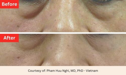 SD Vein Eye Wrinkles Laser Therapy