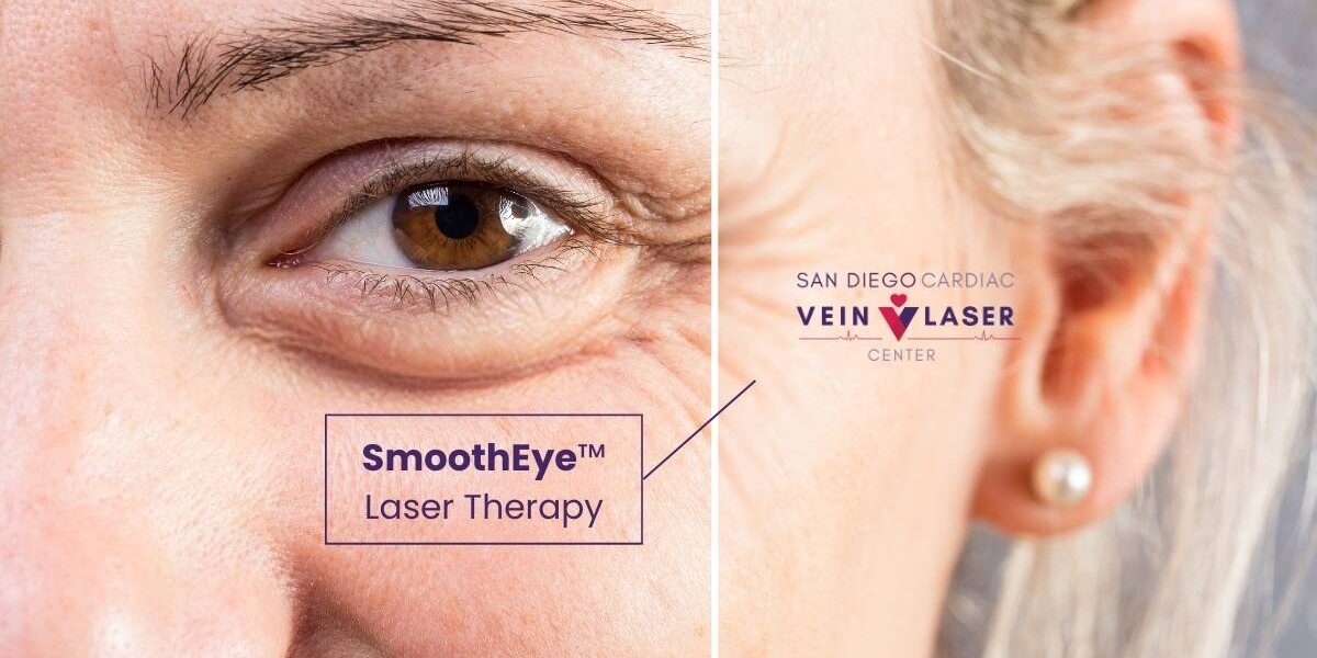 Periorbital Wrinkles (Crow’s Feet) Laser Therapy in San Diego Periorbital Wrinkles (Crow's Feet) Laser Therapy in San Diego