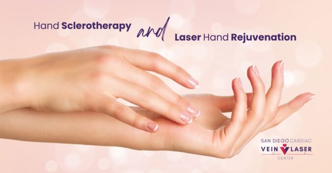 SD Vein Hand Sclerotherapy and Laser Hand Rejuvenation Treatments
