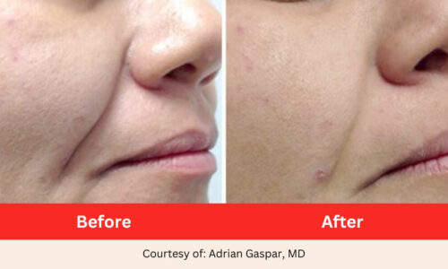SD Vein Laser Facelift and Facial Rejuvenation Laser Therapy 2