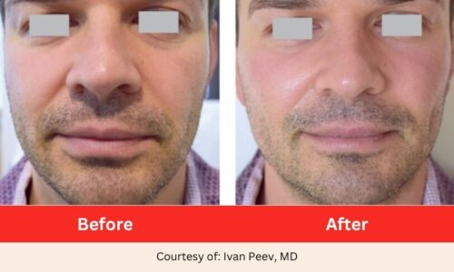 SD Vein Laser Facelift and Facial Rejuvenation Laser Therapy 3