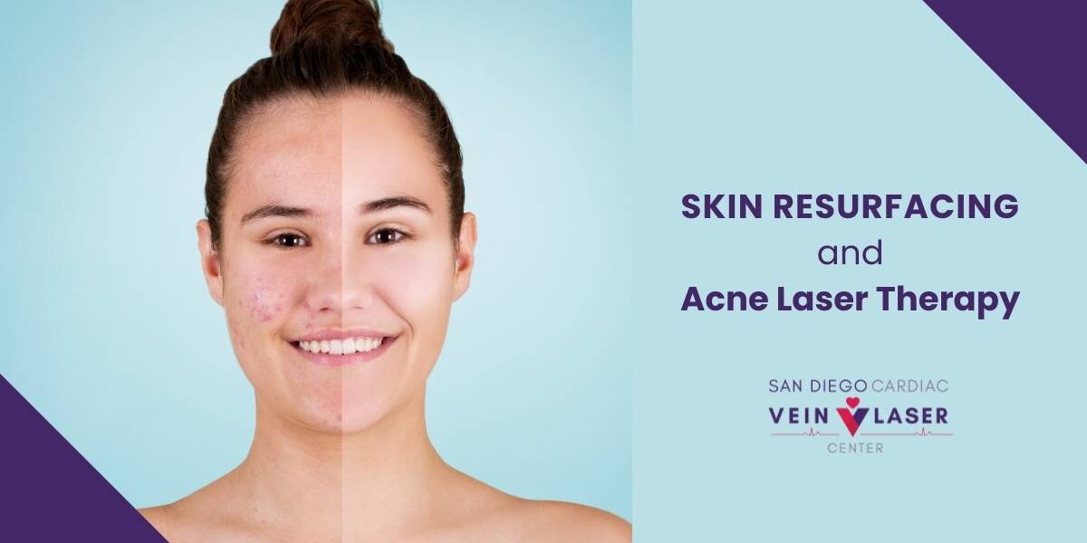 SD Vein Skin Resurfacing and Acne Laser Therapy