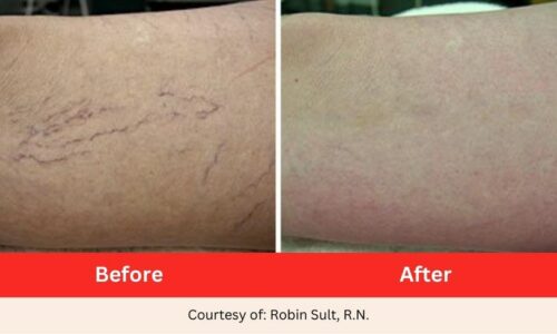 SD Vein Vein and Vascular Lesions Laser Therapy before after 2 (1)