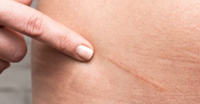 Scar and Striae laser Therapy