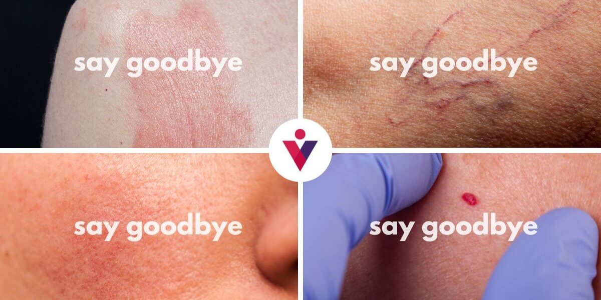 Vein and Vascular Lesion Laser Therapy