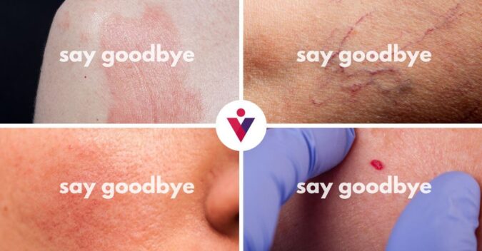 Vein and Vascular Lesion Laser Therapy