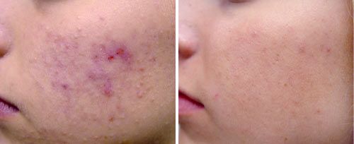 acne before and after acne before and after