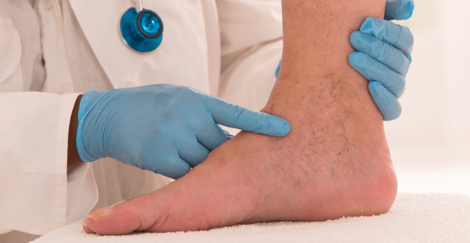 benefits-of-radiofrequency-ablation-rfa-for-varicose-veins