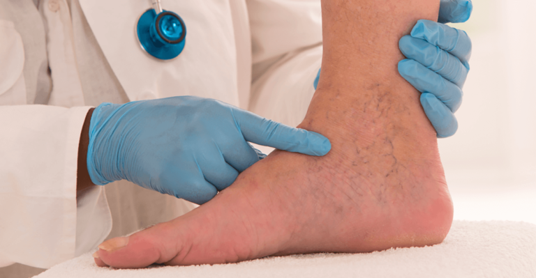 benefits-of-radiofrequency-ablation-rfa-for-varicose-veins