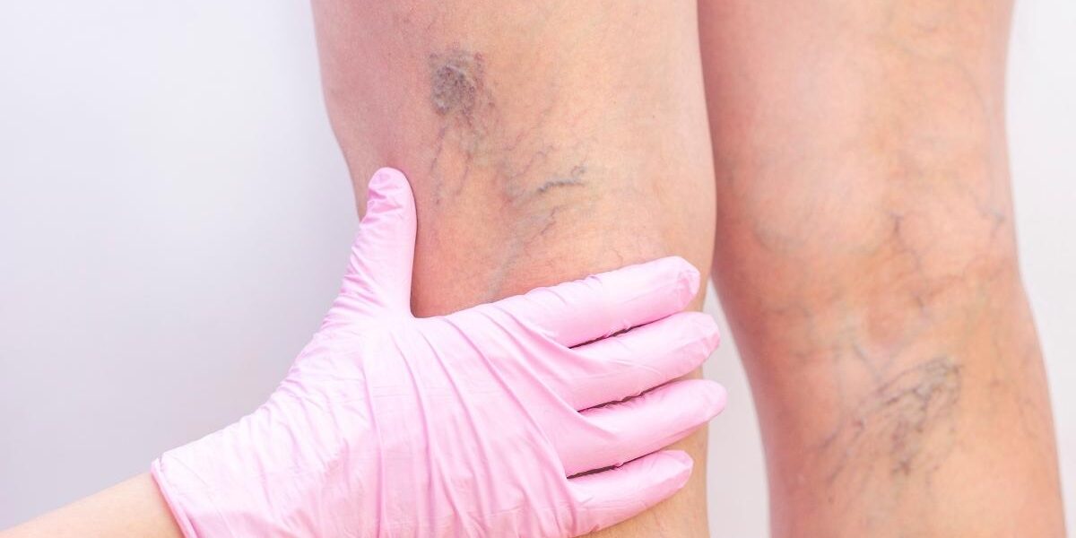 Personalized Cosmetic and Medical Vein Treatments
