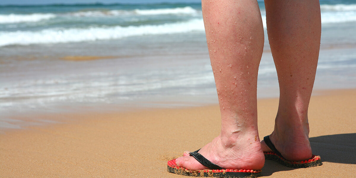 picioare varicose beach