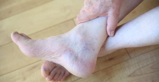 how-to-treat-spider-veins-on-the-face-ankles-and-legs