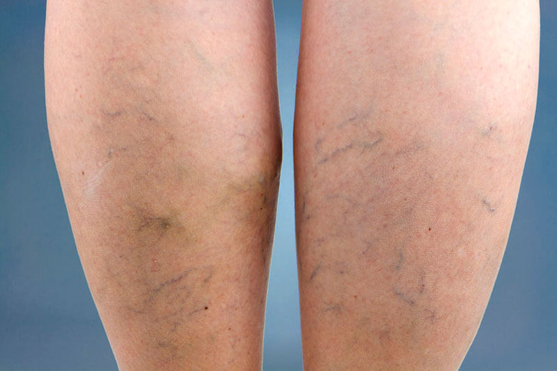 san-diego-varicose-vein-treatment-before-after