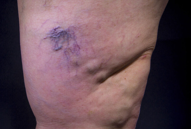 san-diego-varicose-vein-treatment-before-after