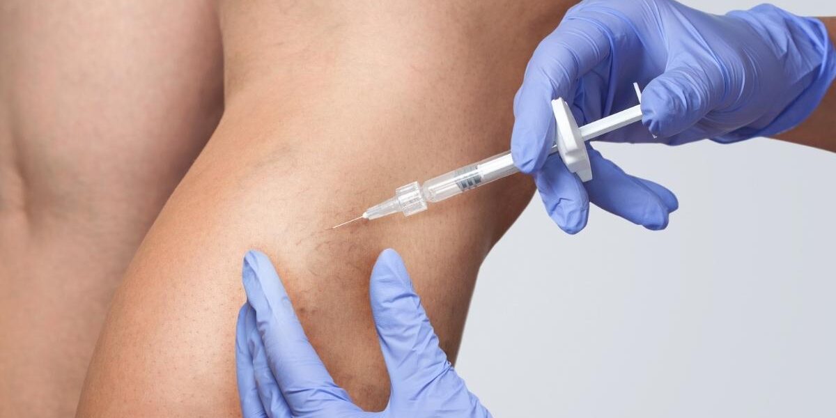 San Diego Varicose Vein Treatment Center Sclerotherapy Vein Treatment