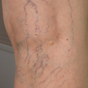 san diego varicose vein treatment vein and vascular lesions