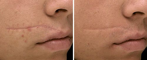 scar before and after scar before and after