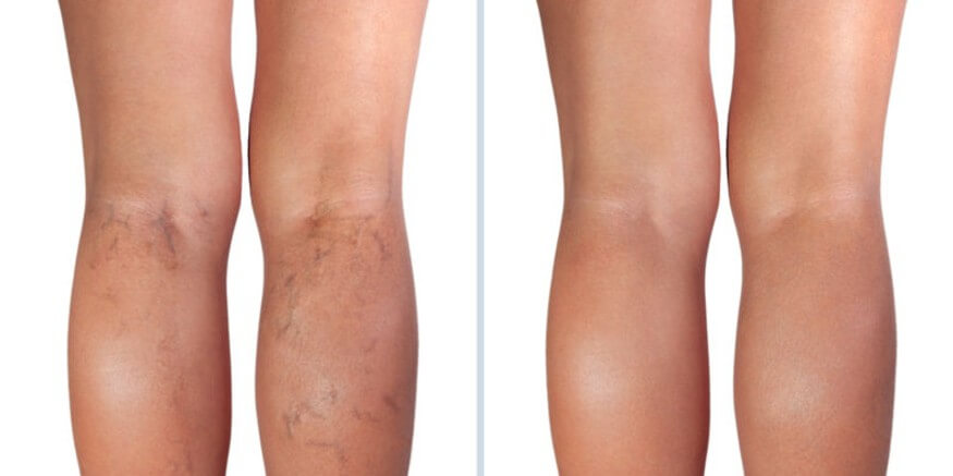 Before and After Varicose Vein and Spider Vein Treatment - San Diego Varicose  Vein Treatment Center