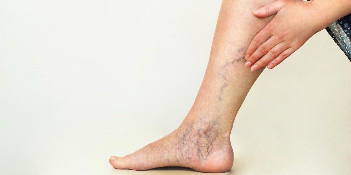 work related varicose veins work related varicose veins