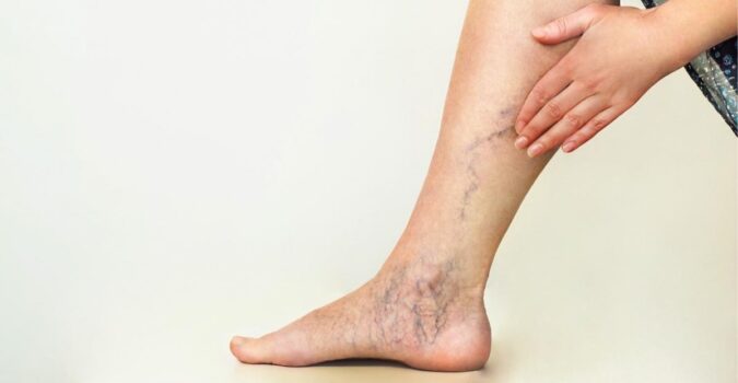 work related varicose veins