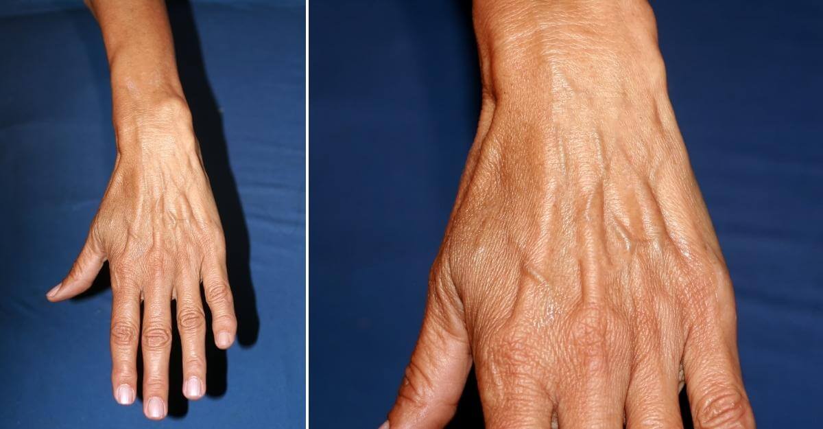 hand-vein-causes-treatments-san-diego-cardiac-vein-and-laser-center