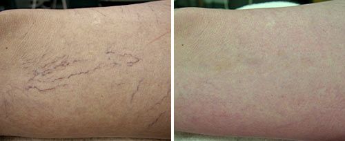 spider vein before and after spider vein before and after